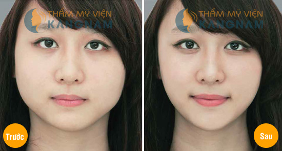 Trước và sau khi phẫu thuật gọt mặt tại kangnam