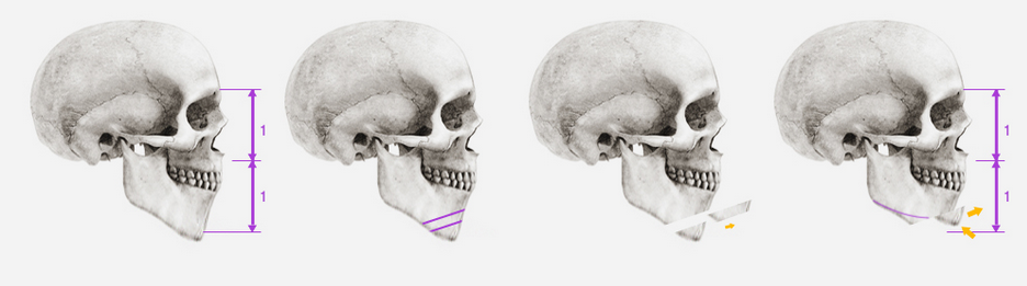 thẩm mỹ khuôn mặt V-line 3D 