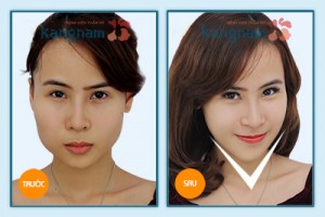 Phẫu thuật gọt mặt V line 3D công nghệ Hàn Quốc 3