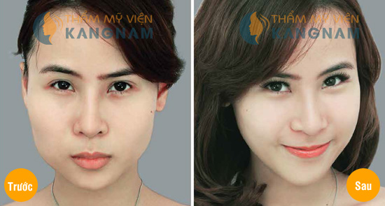 tham-my-khuon-mat-v-line