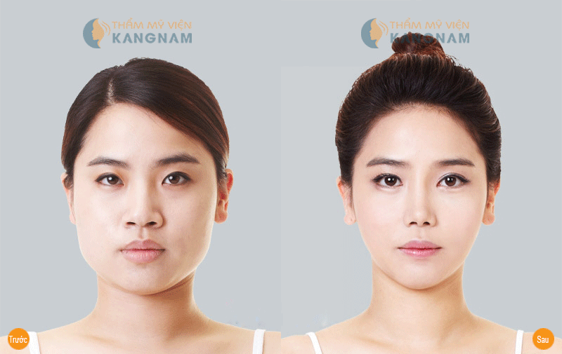 Tham-my-khuon-mat-v-line-3d
