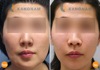 Tham-my-khuon-mat-v-line