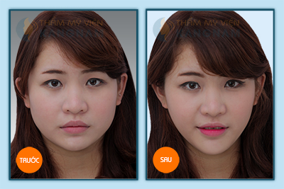 Hinh-anh-tham-my-khuon-mat-v-line-3D