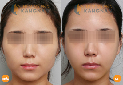khuôn mặt V-Line 3D