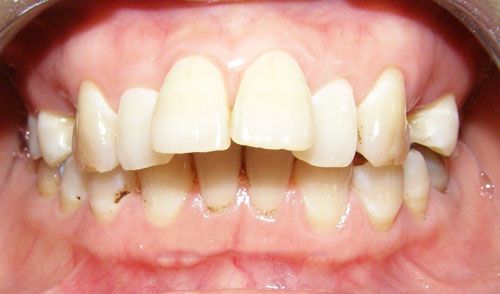 Cách chữa răng hô tại nhà hiệu quả mà bạn không thể bỏ qua