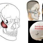 Phẫu thuật hạ gò má có đau không ?