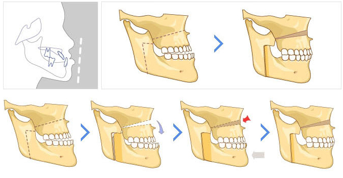 Chỉnh răng hô ở đâu tốt nhất Hà Nội? 2