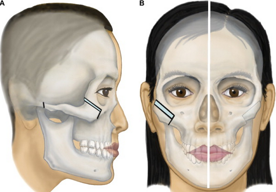 Gò má cao có phải sát chồng không? 5