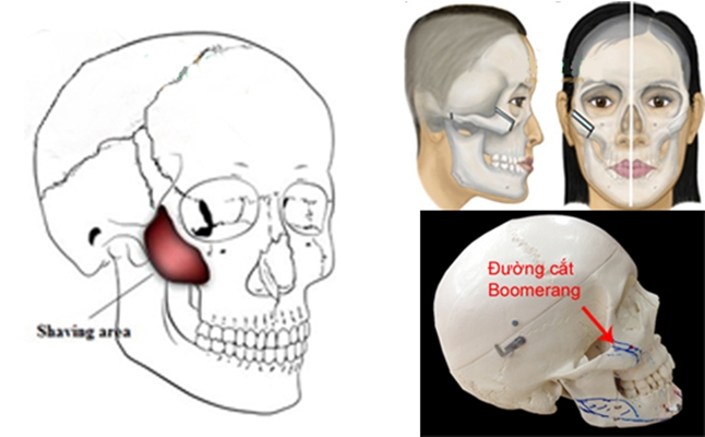 Gò má rộng khắc phục bằng phương pháp nào? 2