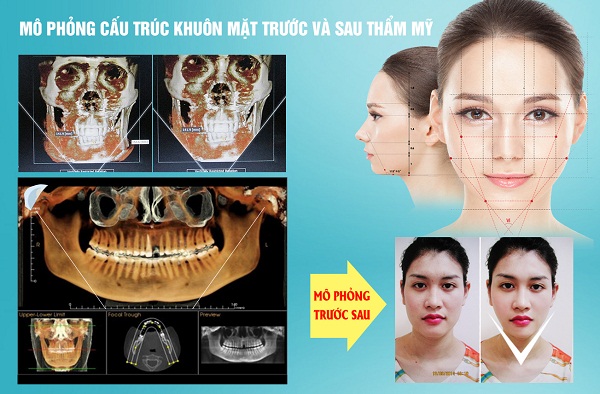 Gọt cằm có đau không?