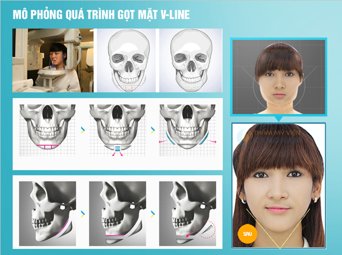 gọt mặt V-Line 3D