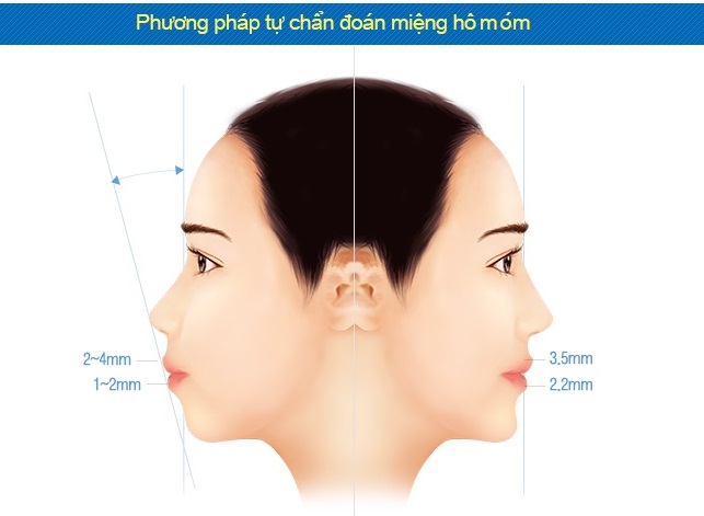 Phẫu thuật chỉnh hàm hô món công nghệ 3D có cho kết quả vĩnh viễn?