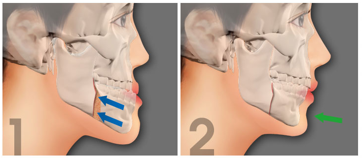 Phẫu thuật chỉnh hàm móm ở đâu tốt nhất? 2