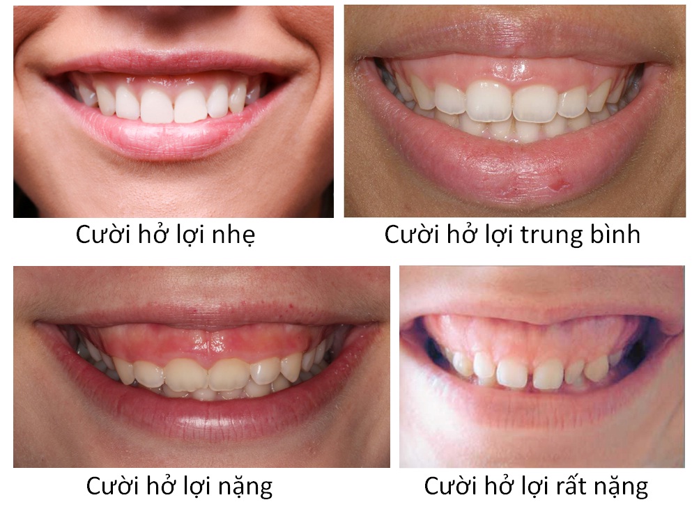 Phẫu thuật cười hở lợi hết bao nhiêu tiền?