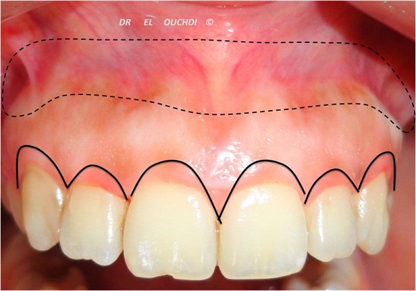 PHẪU THUẬT CƯỜI HỞ LỢI CÓ NGUY HIỂM KHÔNG?