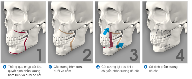 chỉnh hàm hô móm 2