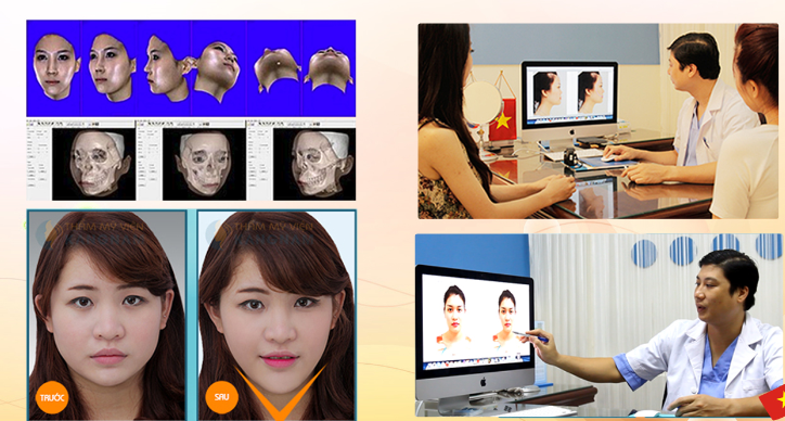 Tham-my-khuon-mat-v-line-3d